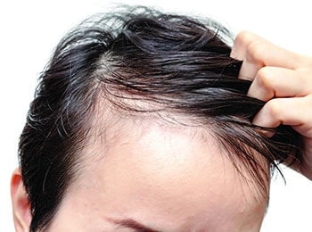 Cause of hair loss in men