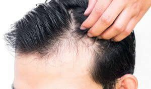 What causes hair fall