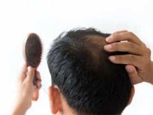 Hair Fall in Men